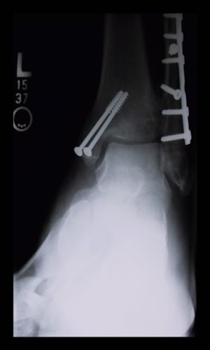 An ankle, broken with screws