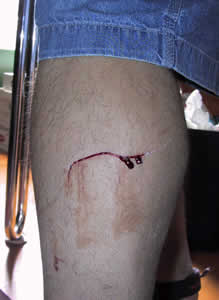 Bloody Leg